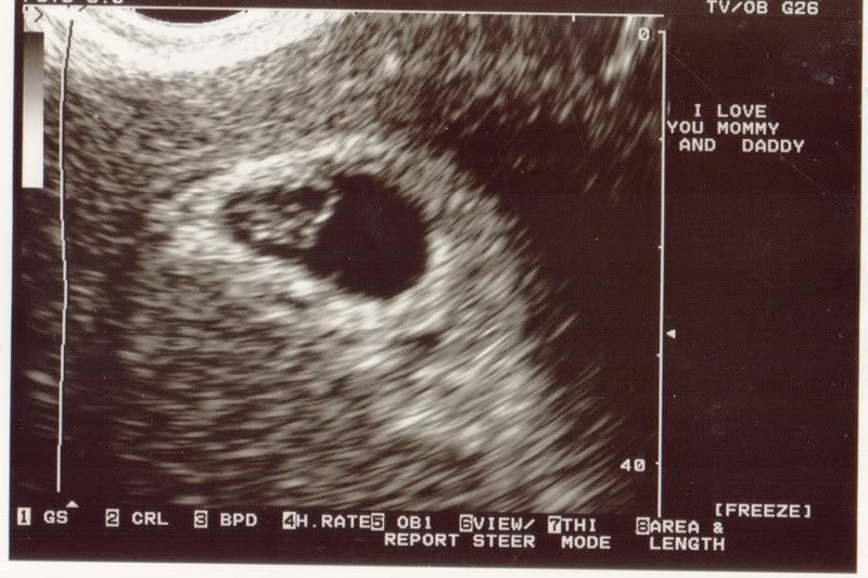 ultrasounds at 6 weeks. ultrasounds at 6 weeks.